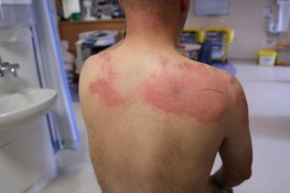 Man with serious burns to his back suffered these in an accident and will need some guidance from Seattle Malpractice Attorneys.