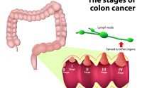 Failure to diagnose colon cancer